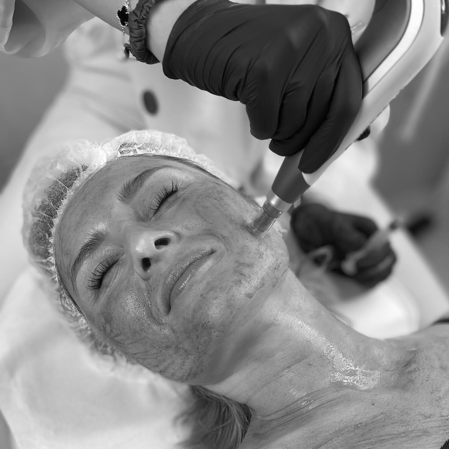 Fibryna bogatopłytkowa