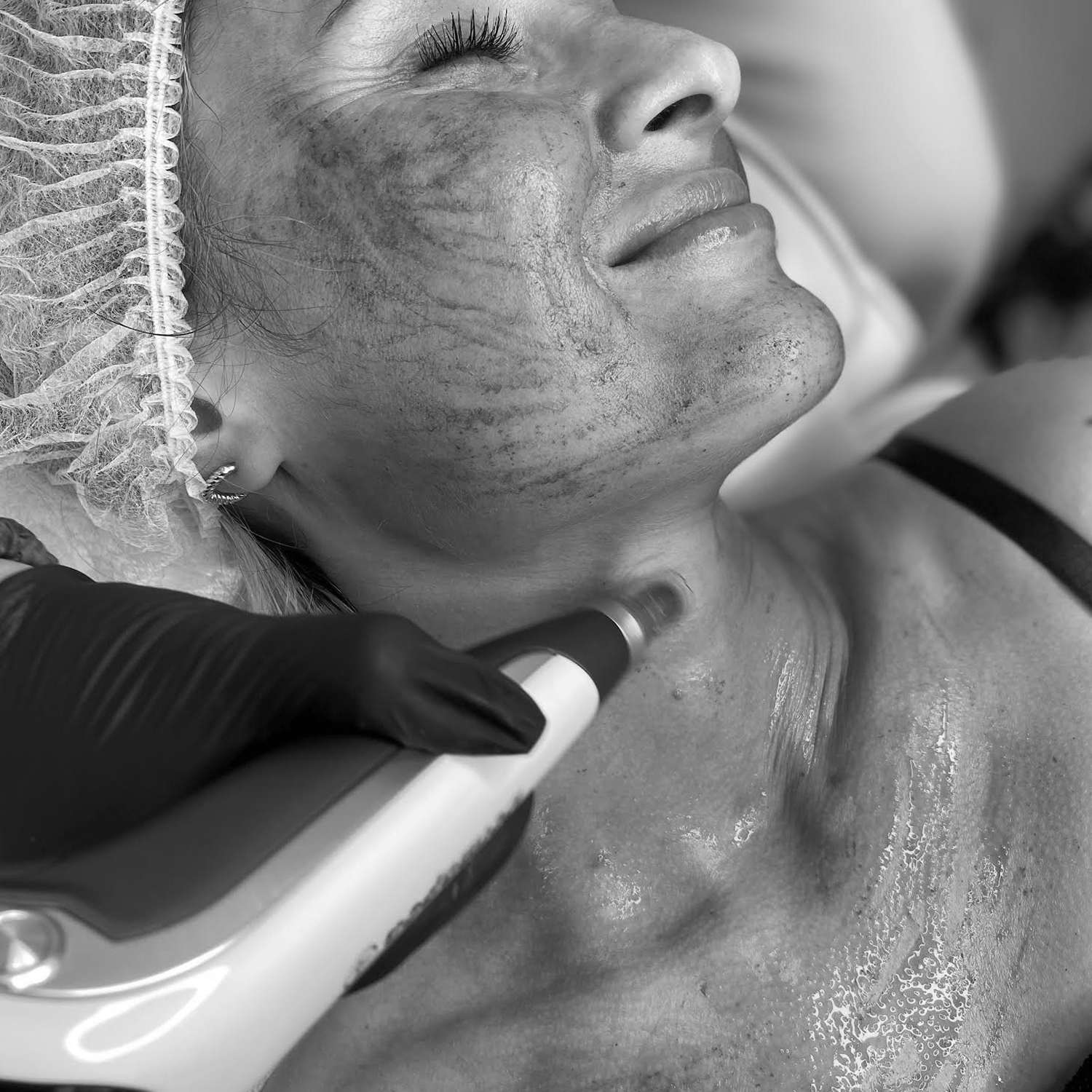 Osocze bogatopłytkowe