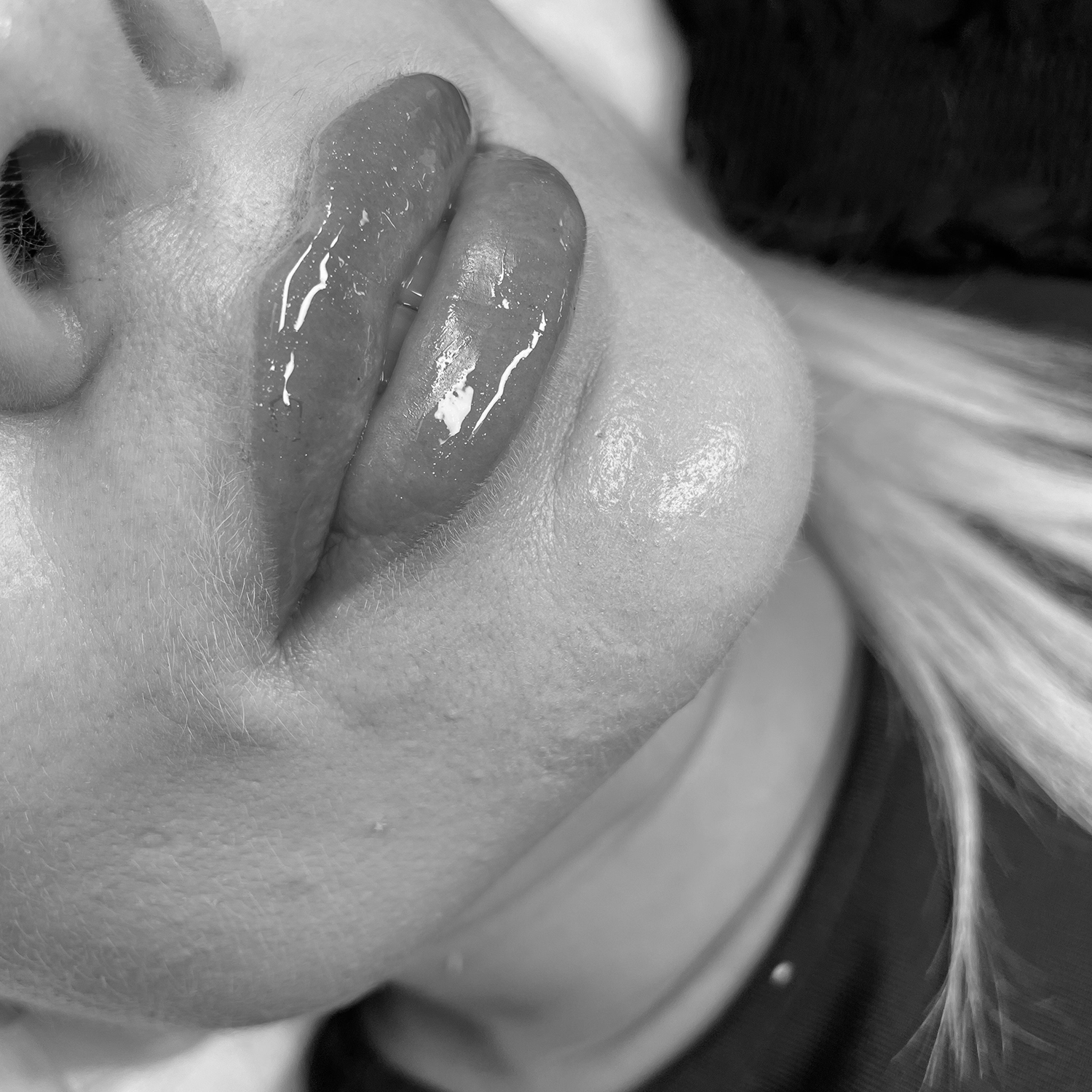 Modelowanie ust kwasem hialuronowym